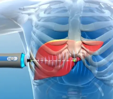 Elastografia Hepática