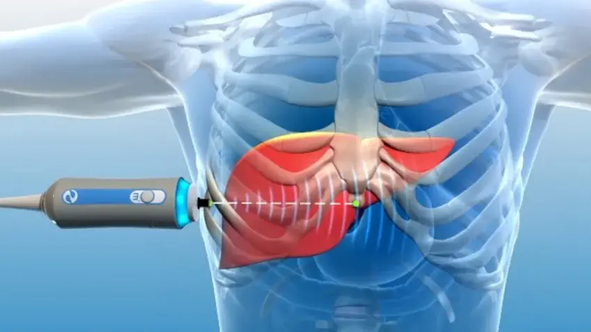 Elastografia Hepática